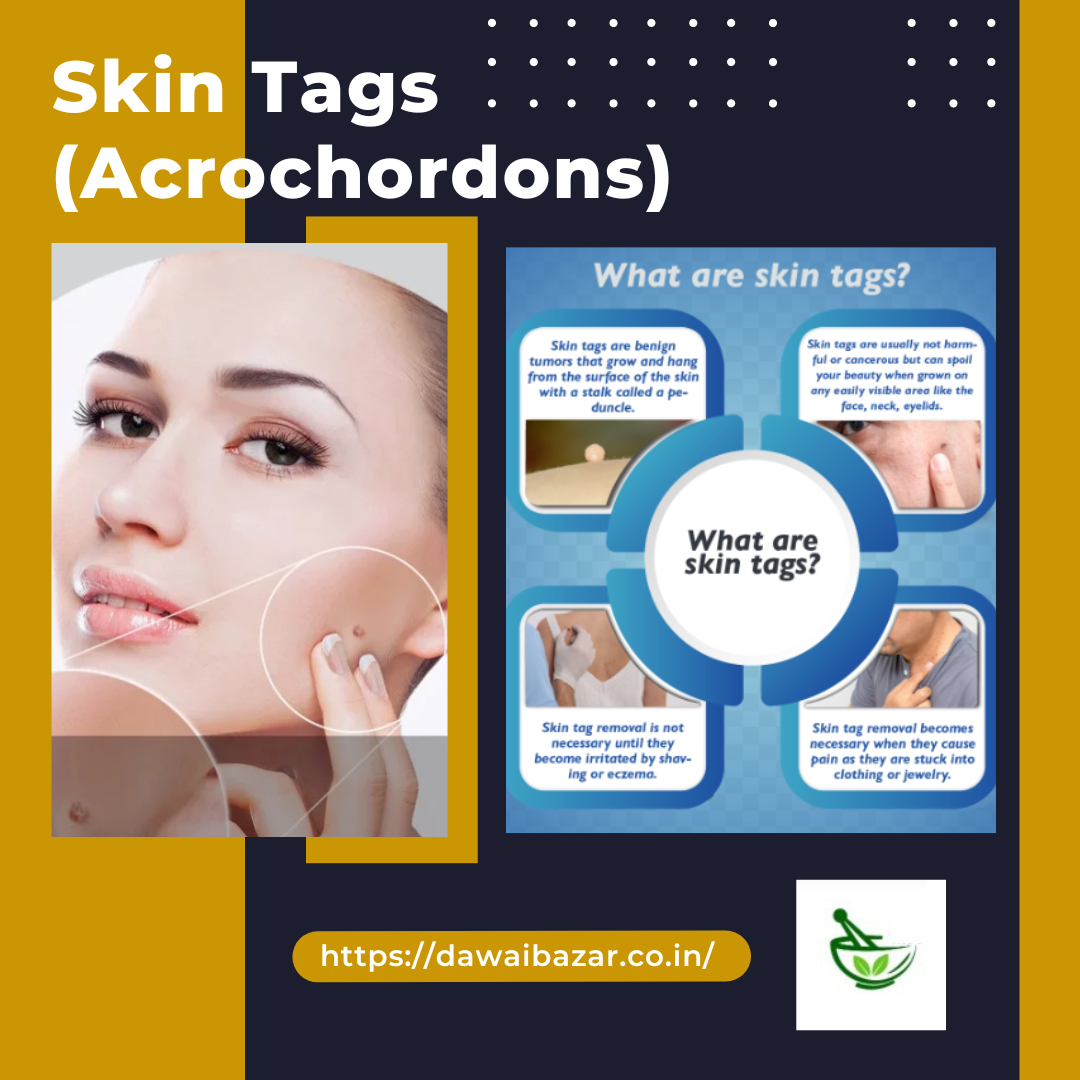 Understanding Skin Tags: Causes, Treatment, and Prevention Tips